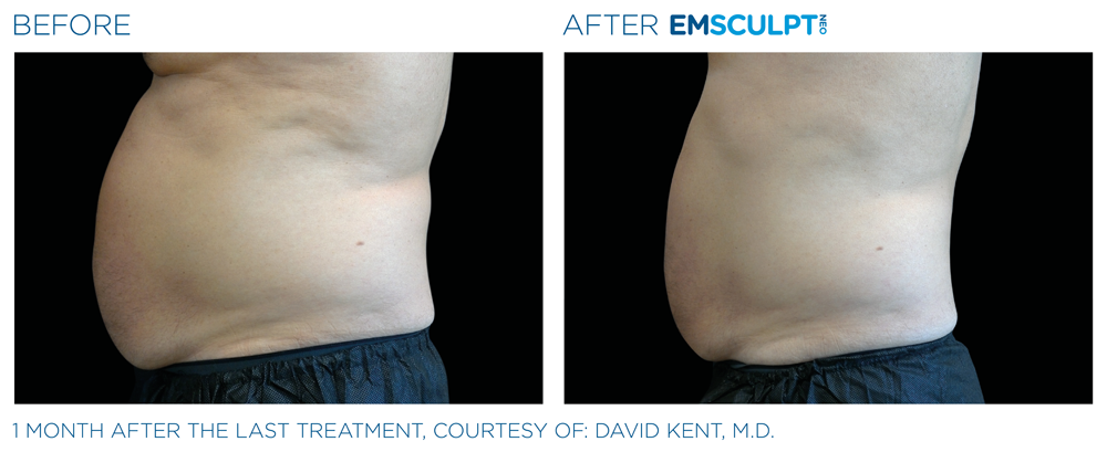 Emsculpt_neo_PIC_Ba-card-male-abdomen-002_EN100
